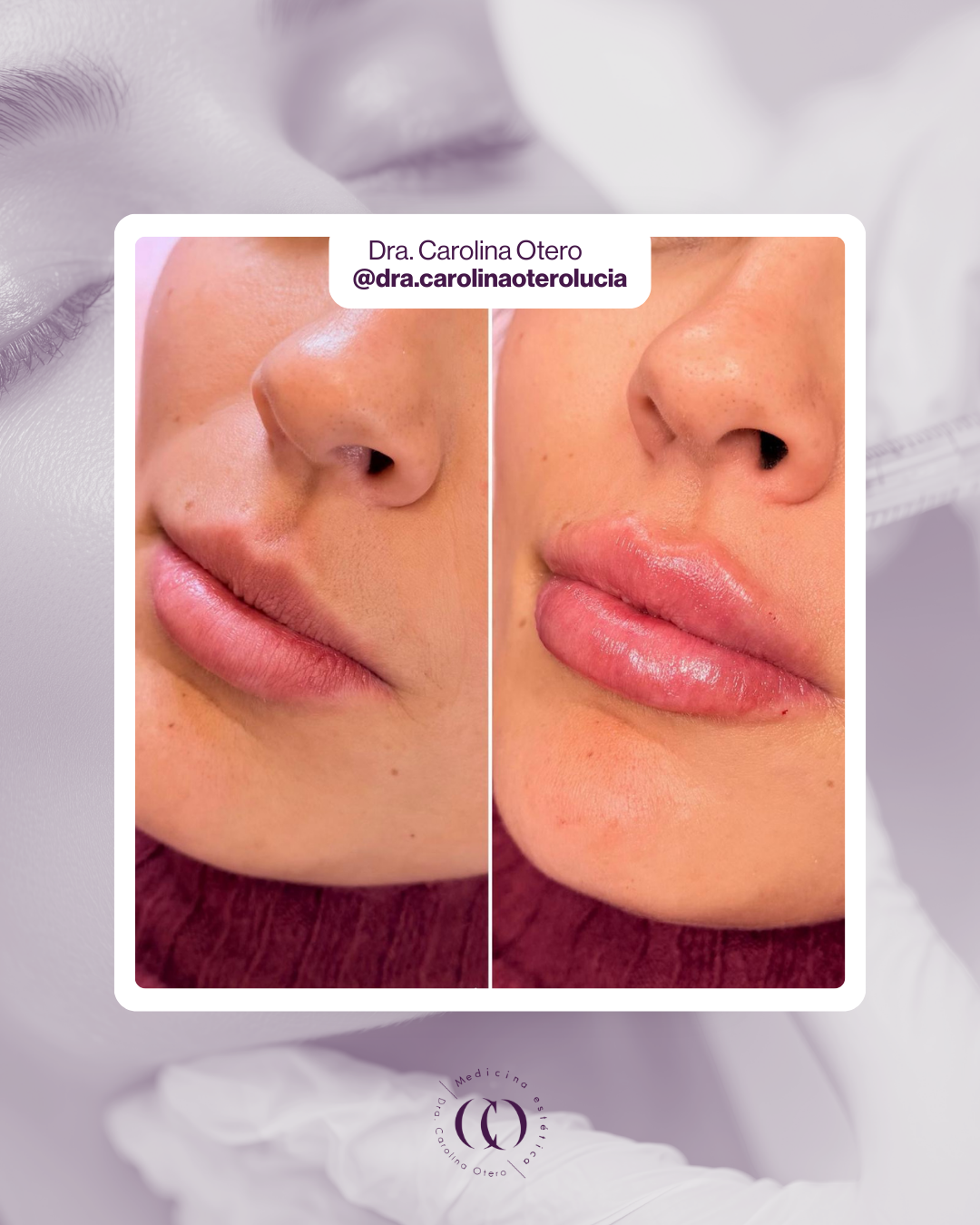 Antes y después labios Carolina Otero Centro SEDA