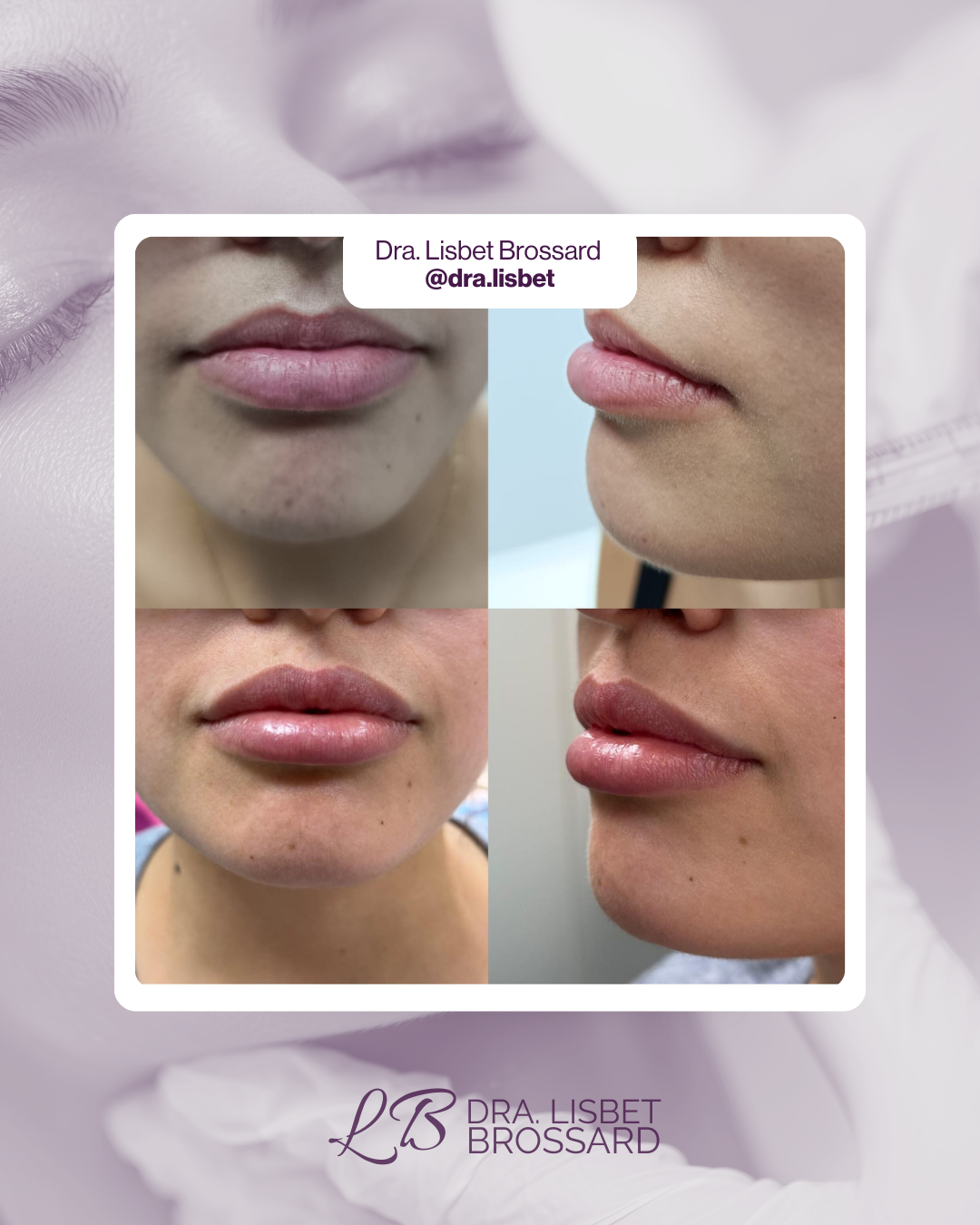 Antes y después aumento de labios Centro SEDA