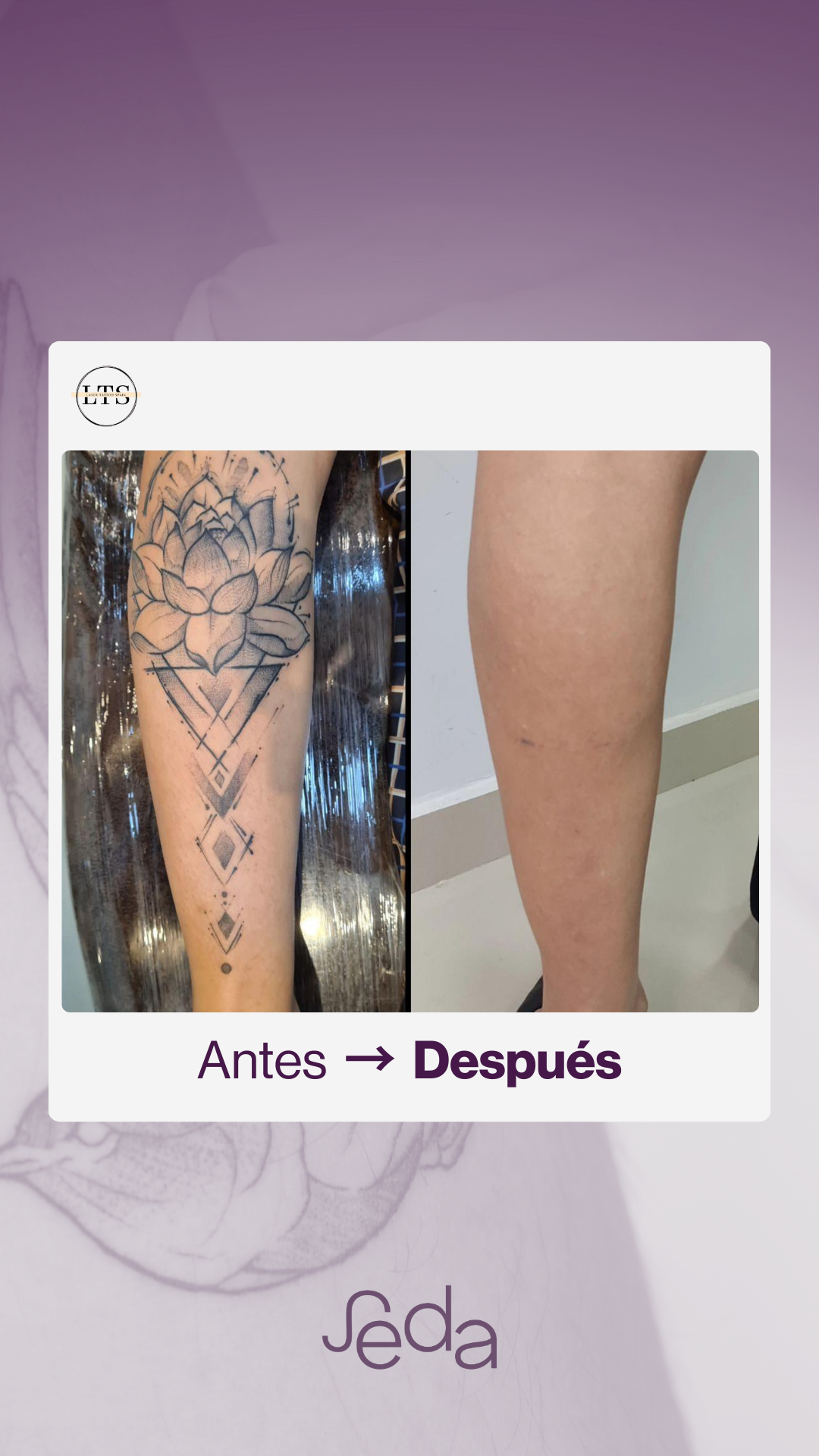 Antes y después eliminación tatuaje Centro SEDA 1
