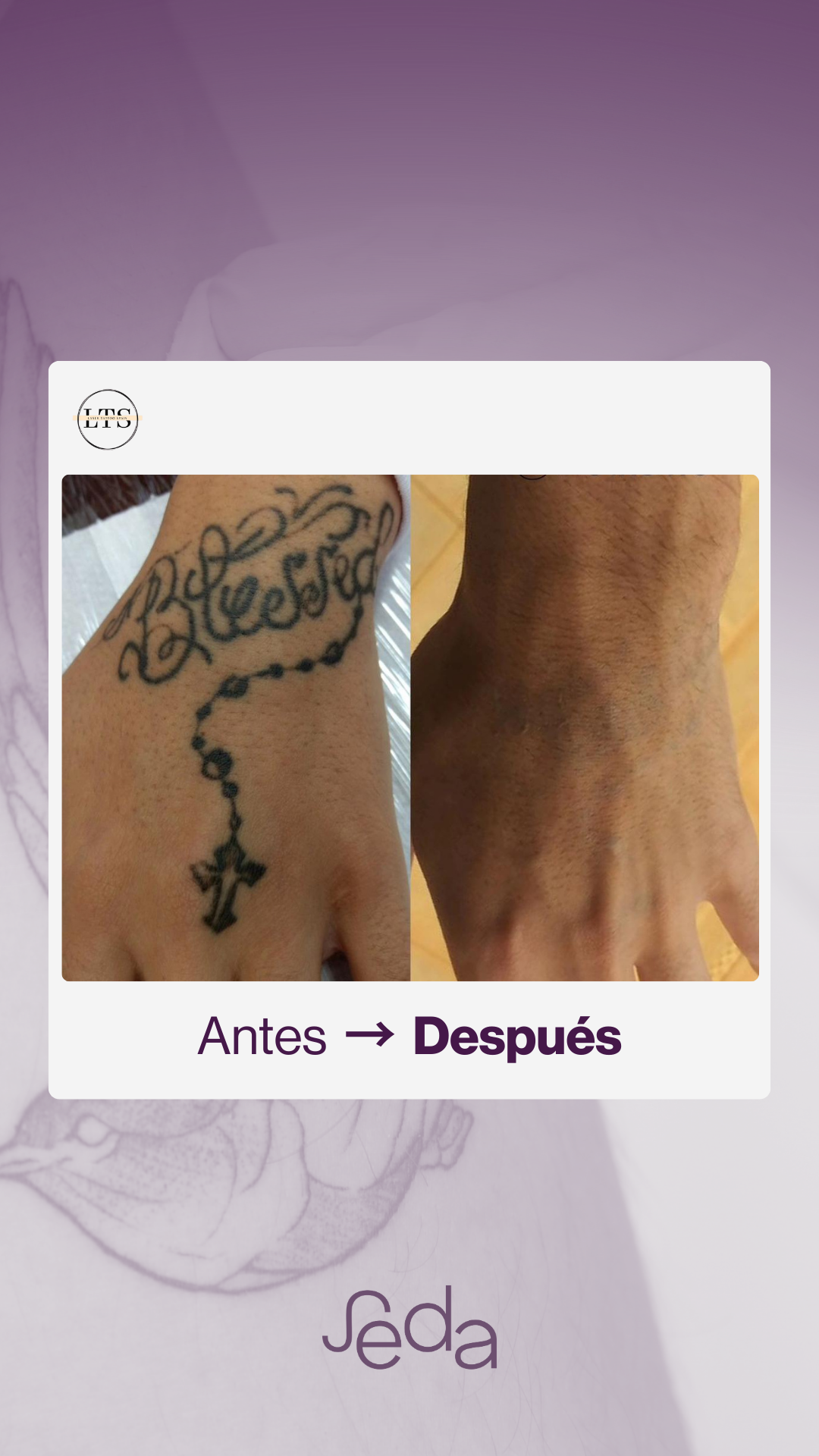 Antes y después eliminación tatuaje Centro SEDA 2